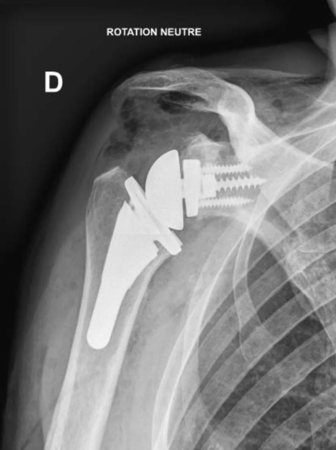 Radiographie d'une épaule droite avec une prothèse inversée : une demi-sphère métallique sur l'omoplate, fixée par des vis, et une tige avec cupule dans le bras.