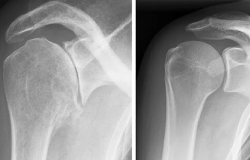 Deux radiographies côte à côte : à gauche une épaule arthrosique, avec un pincement de l'interligne et des becs osseux sur la tête ; à droite une épaule normale avec un interligne lisse et large.