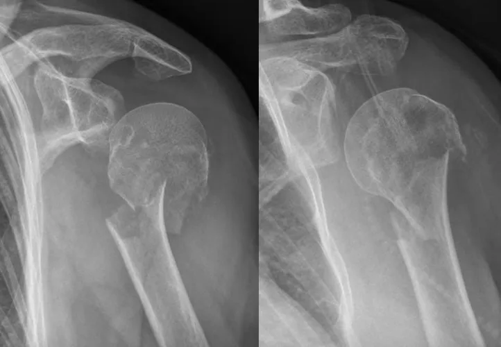 Two X-rays side by side: on the left a fracture of the upper part of the humerus just below the head, with displaced fragments; on the right, for comparison, an upper arm without a fracture.